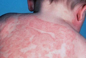 dermatitis tratamiento en zapopan