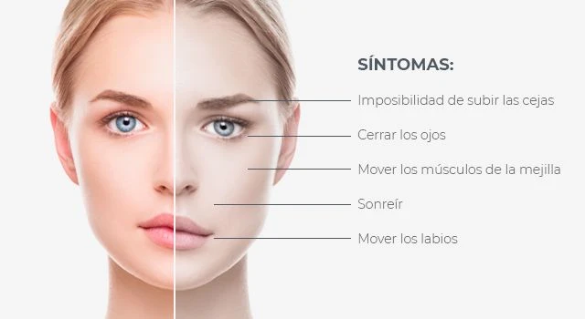 paralisis facial