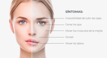paralisis facial